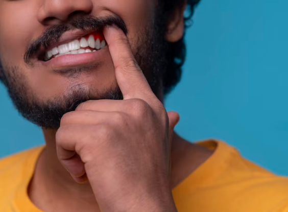 5 Efek Samping Melakukan Veneer Gigi