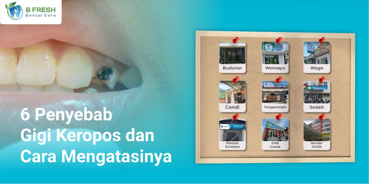6 Penyebab Gigi Keropos Dan Cara Mengatasinya