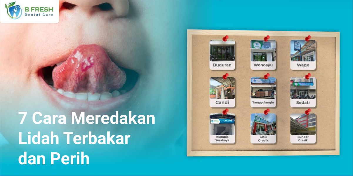 7 Cara Meredakan Lidah Terbakar Dan Perih