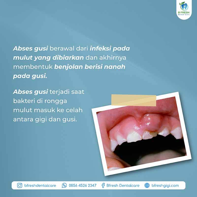 Apa Itu Abses Gigi? Penyebab, Gejala Dan Cara Mengatasinya