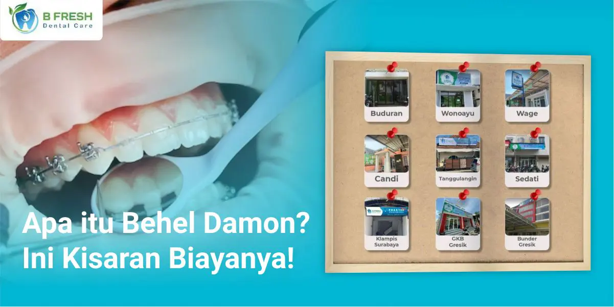 Apa Itu Behel Damon? Ini Kisaran Biayanya!
