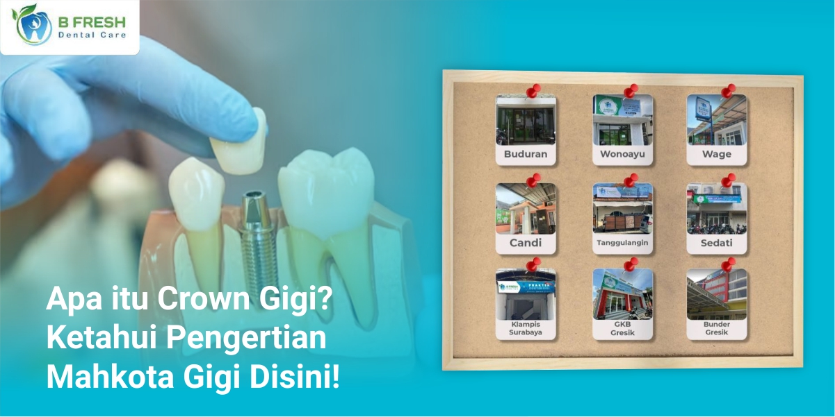 Apa Itu Crown Gigi? Ketahui Pengertian Mahkota Gigi Disini!