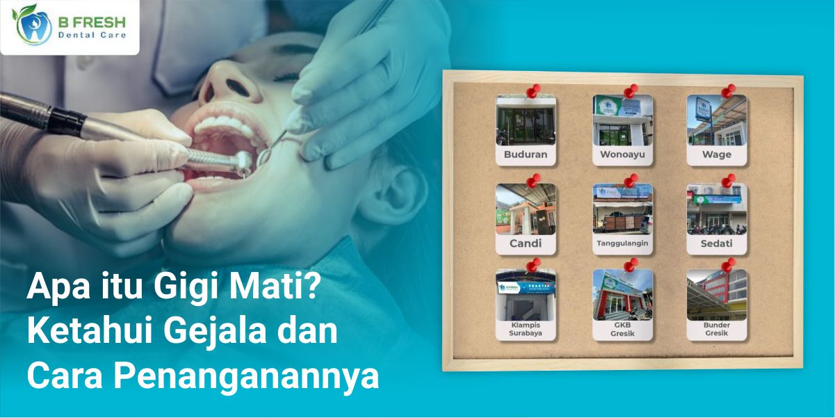 Apa Itu Gigi Mati? Ketahui Gejala Dan Cara Penanganannya