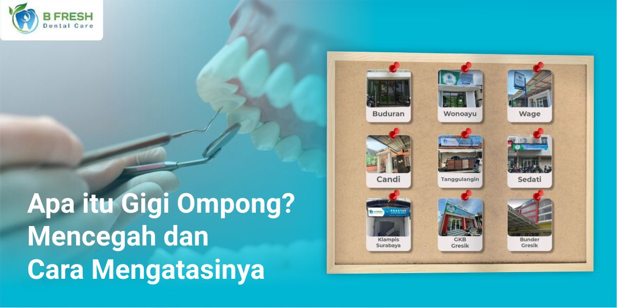 Apa Itu Gigi Ompong? Mencegah Dan Cara Mengatasinya