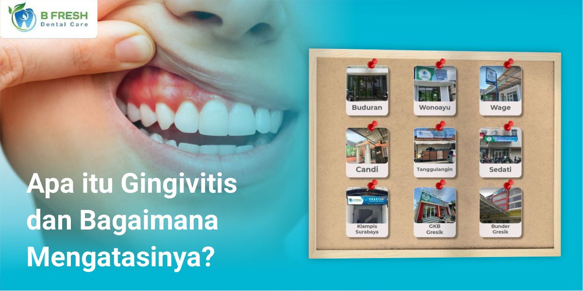 Apa Itu Gingivitis Dan Bagaimana Mengatasinya?
