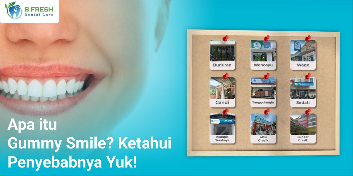 Apa Itu Gummy Smile? Ketahui Penyebabnya Yuk!