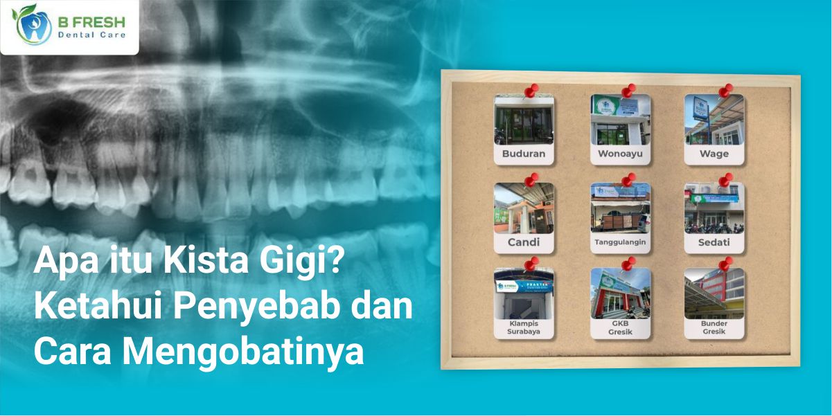 Apa Itu Kista Gigi? Ketahui Penyebab Dan Cara Mengobatinya