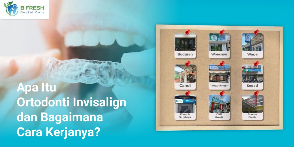 Apa Itu Ortodonti Invisalign Dan Bagaimana Cara Kerjanya?