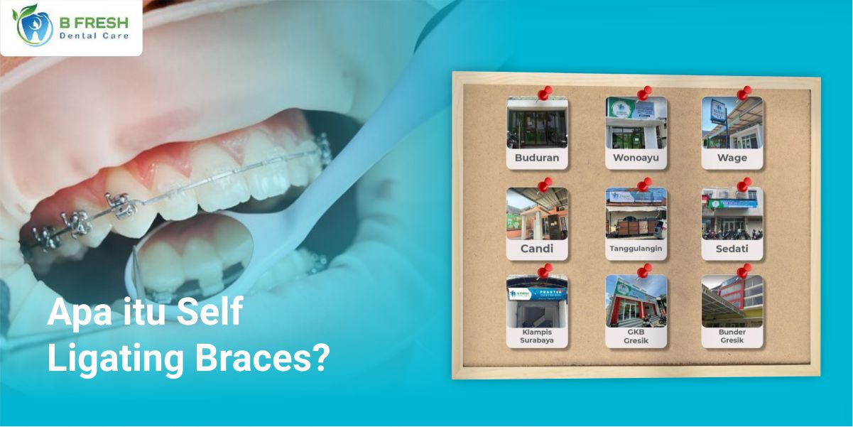 Self Ligating Braces vs Conventional Braces