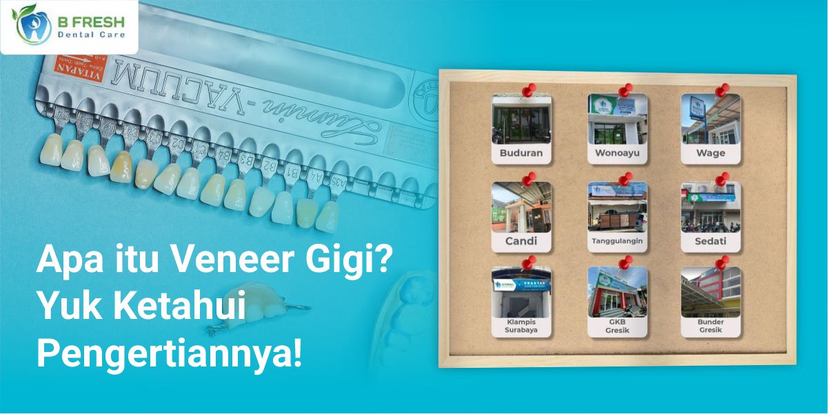Apa Itu Veneer Gigi? Yuk Ketahui Pengertiannya!