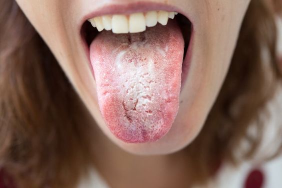 Infeksi Jamur Di Mulut? Penyebabnya Candidiasis Oral!