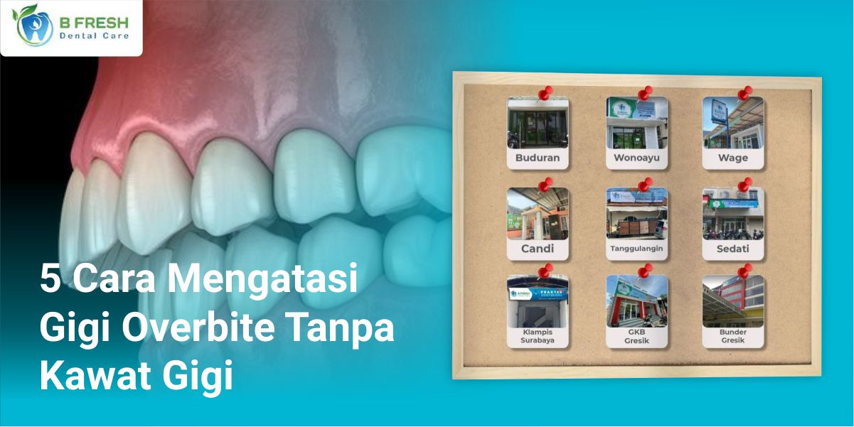 5 Cara Mengatasi Gigi Overbite Tanpa Kawat Gigi