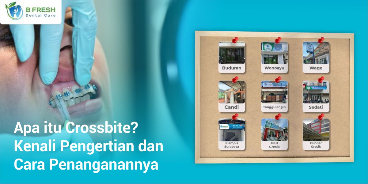 Apa Itu Crossbite? Kenali Pengertian Dan Cara Penanganannya