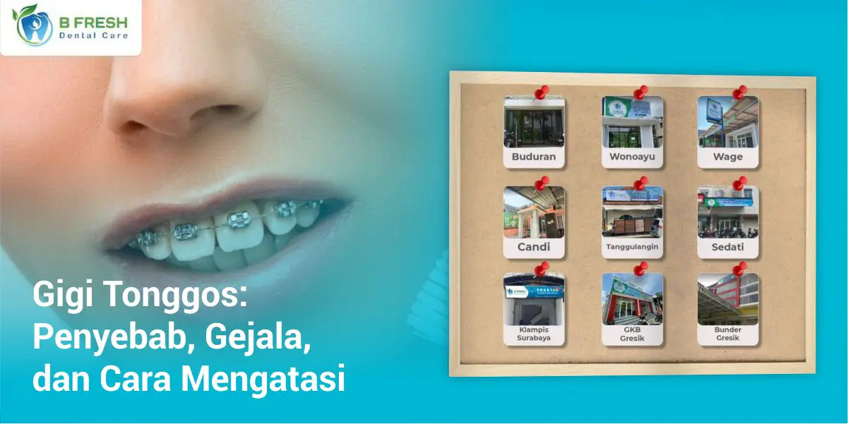 Gigi Tonggos – Penyebab, Gejala, Dan Cara Mengatasi