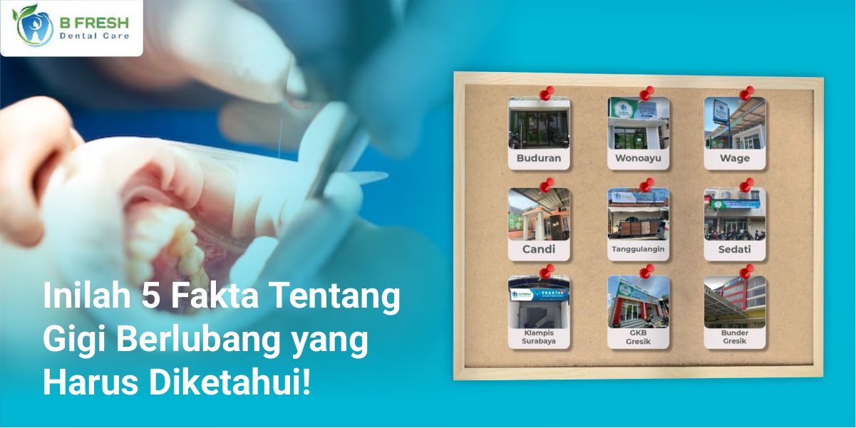 Inilah 5 Fakta Tentang Gigi Berlubang Yang Harus Diketahui!