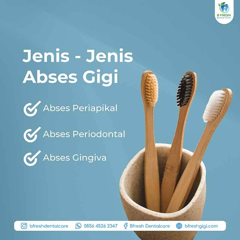 Jenis Jenis Abses Gigi
