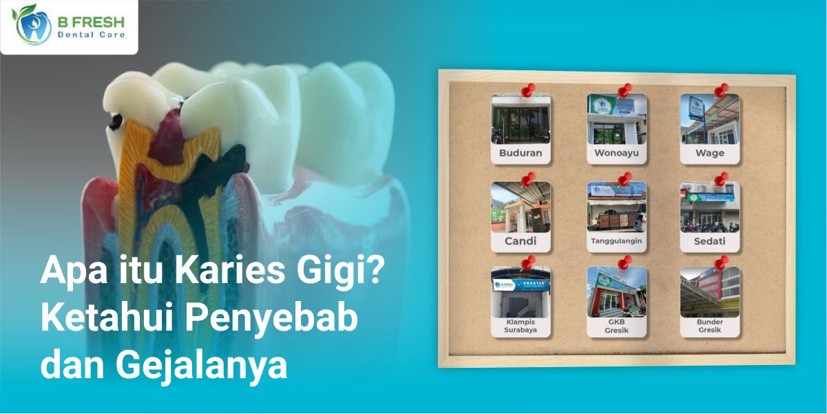 Apa Itu Karies Gigi? Ketahui Penyebab Dan Gejalanya