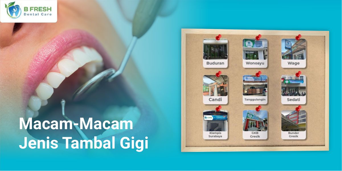 Macam-Macam Jenis Tambal Gigi