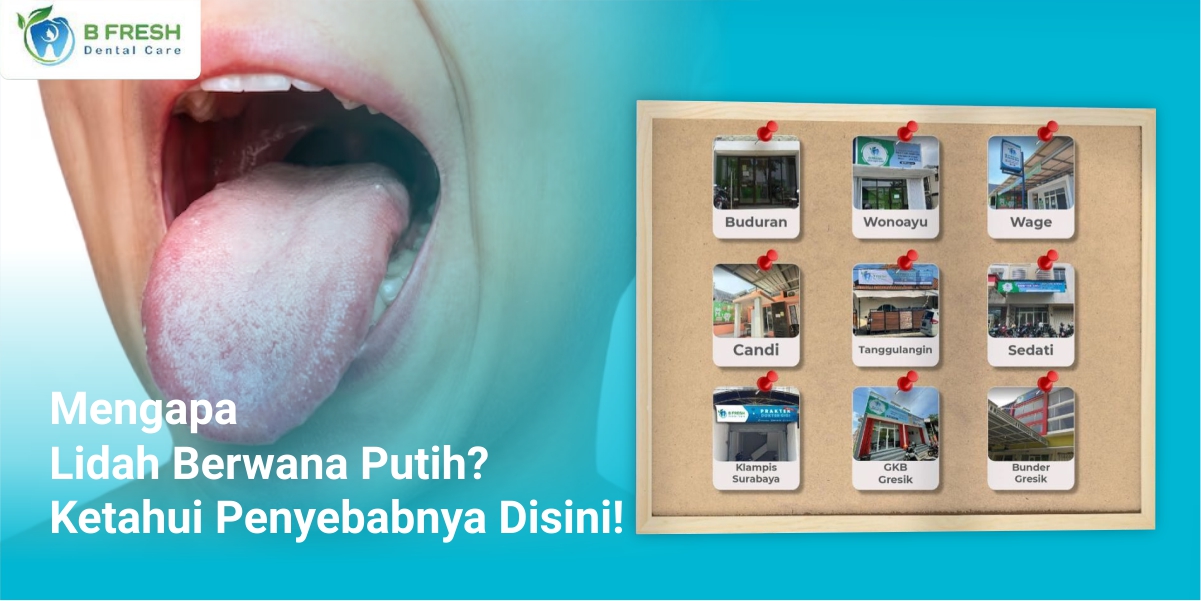 Mengapa Lidah Berwana Putih? Ketahui Penyebabnya Disini!