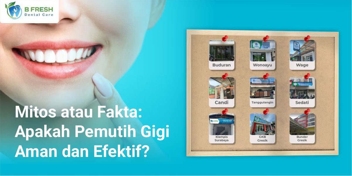 Mitos Atau Fakta: Apakah Pemutih Gigi Aman Dan Efektif?