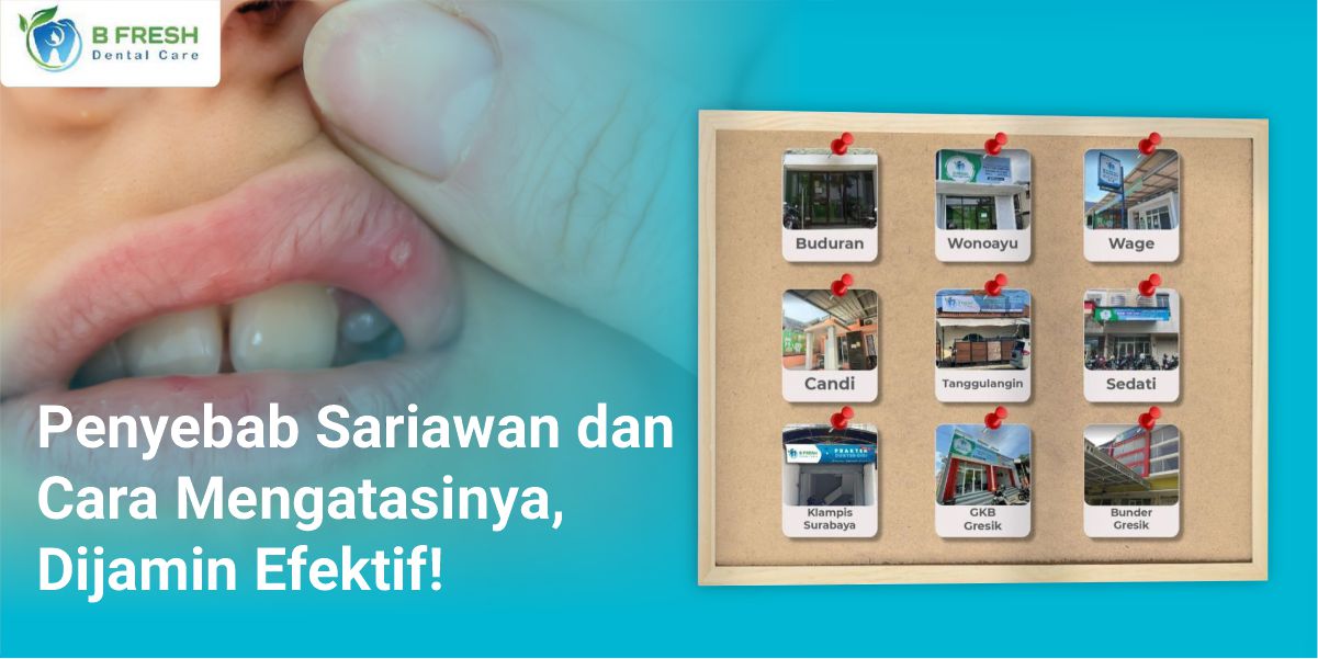 Penyebab Sariawan Dan Cara Mengatasinya, Dijamin Efektif!