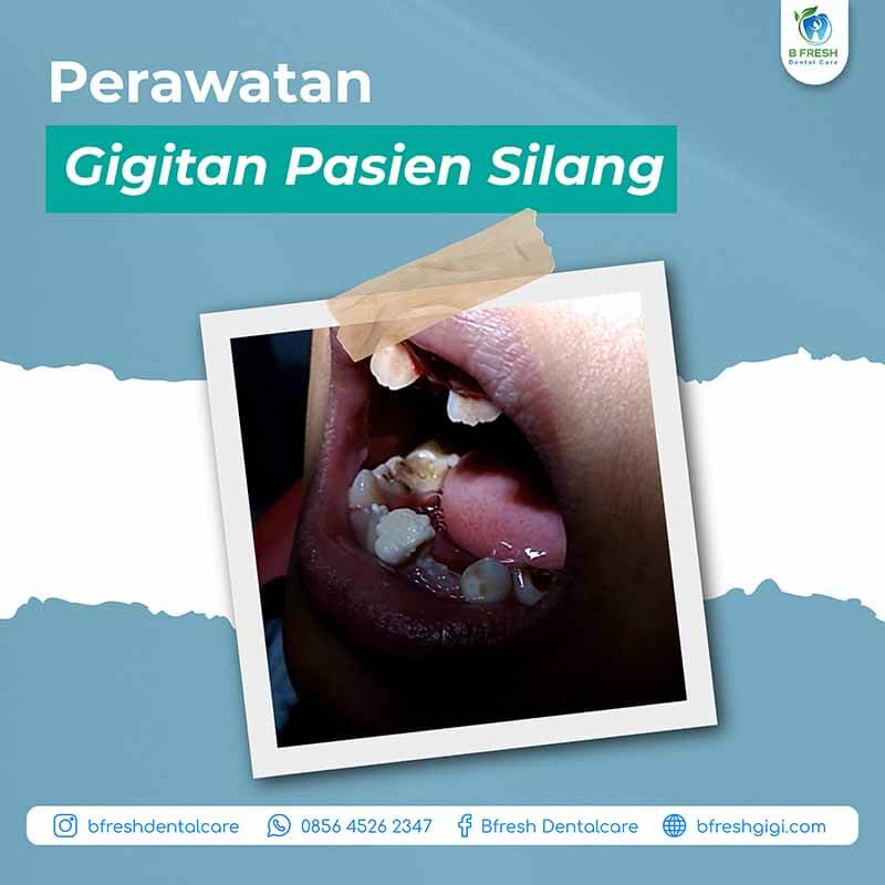 Perawatan Gigi Pasien Silang