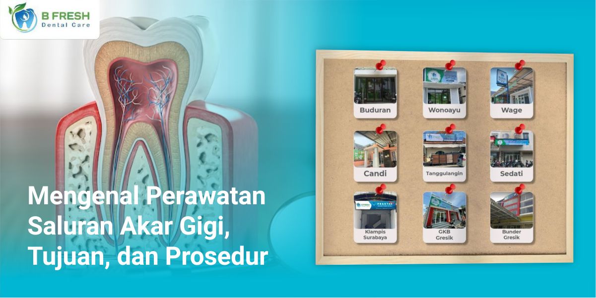 Mengenal Perawatan Saluran Akar Gigi, Tujuan, Dan Prosedur