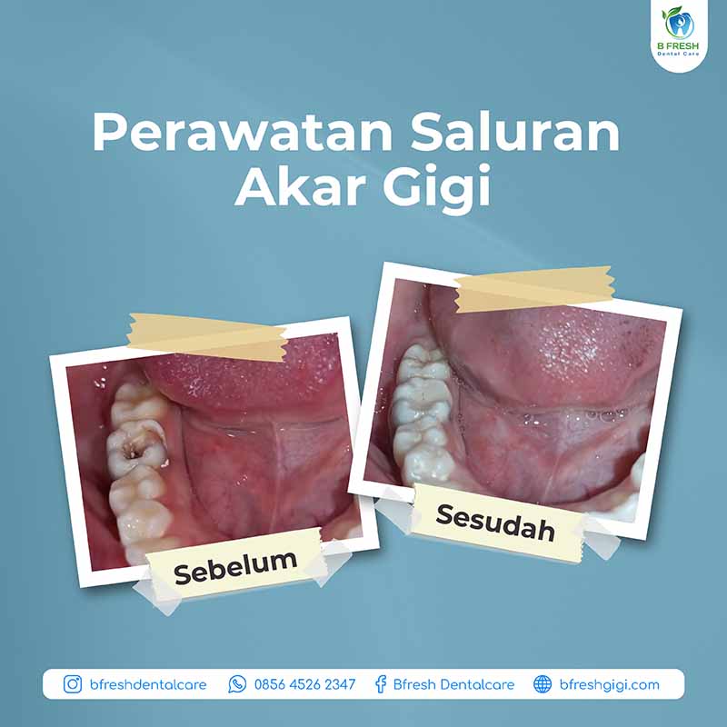 Perawatan Saluran Akar Gigi