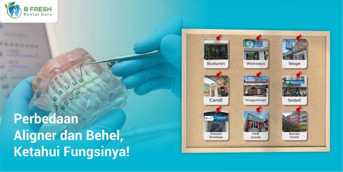 Perbedaan Aligner Dan Behel, Ketahui Fungsinya!