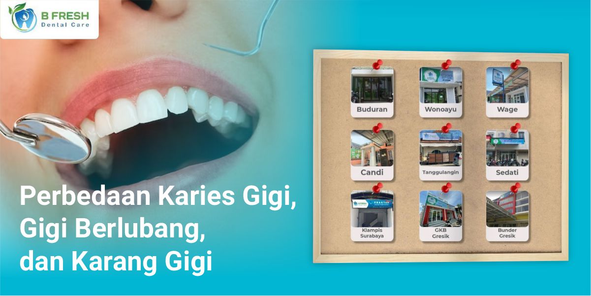 Perbedaan Karies Gigi, Gigi Berlubang, Dan Karang Gigi