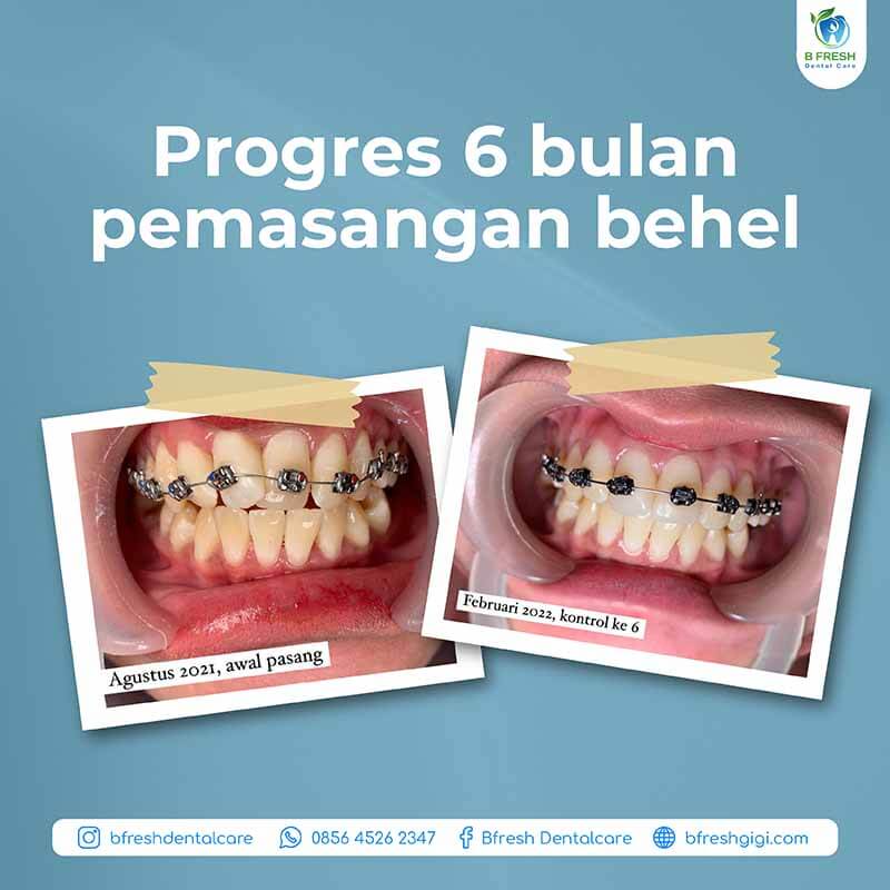 Progress 6 Bulan Pemasangan Behel Gigi