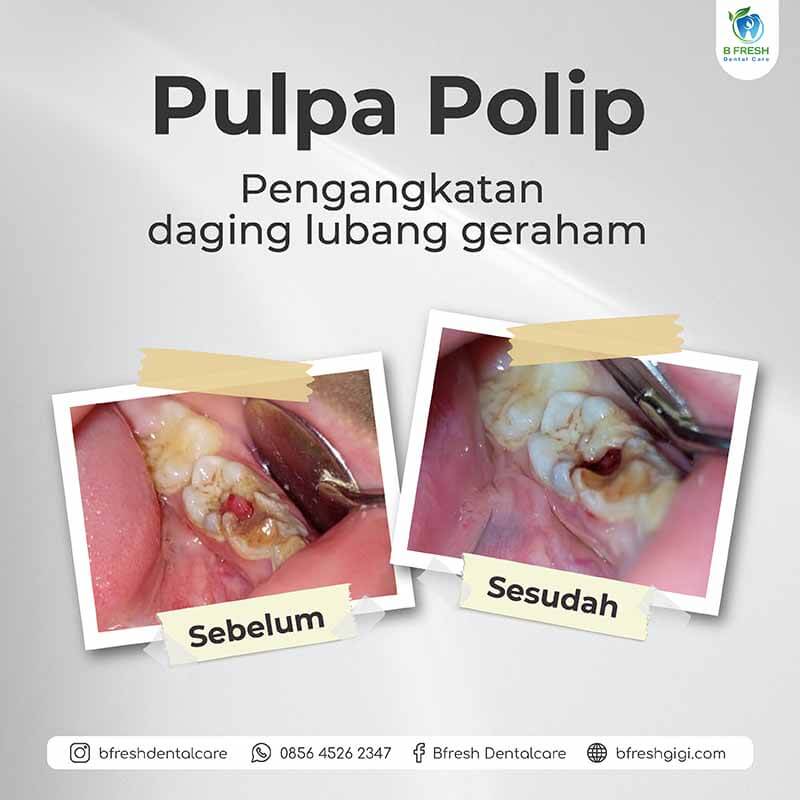 Pulpa Polip