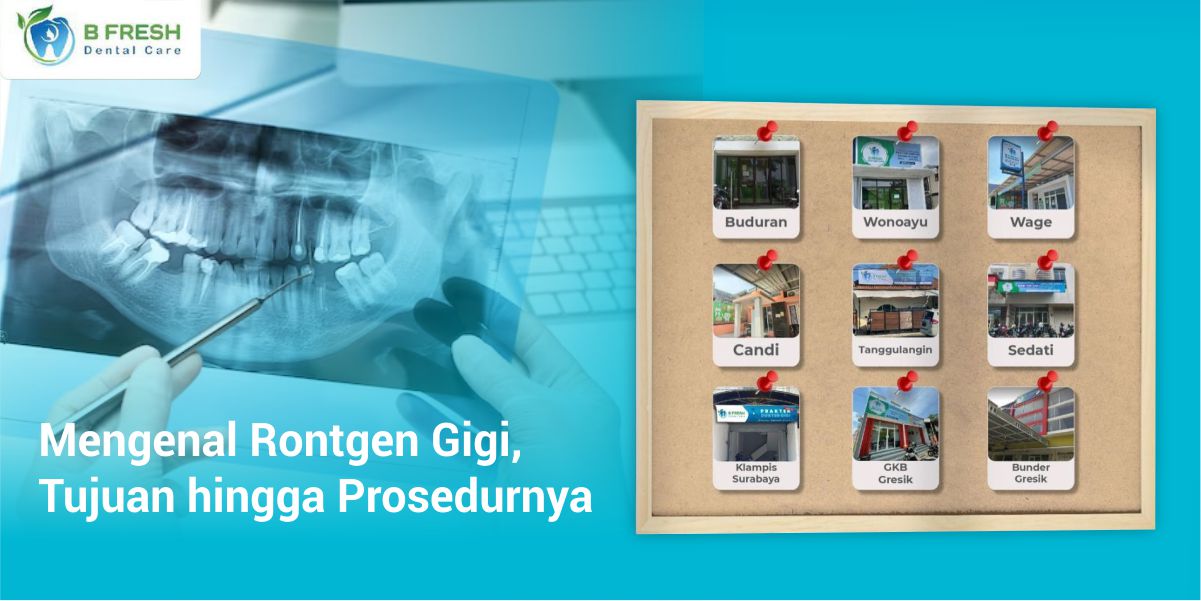 Mengenal Rontgen Gigi, Tujuan Hingga Prosedurnya