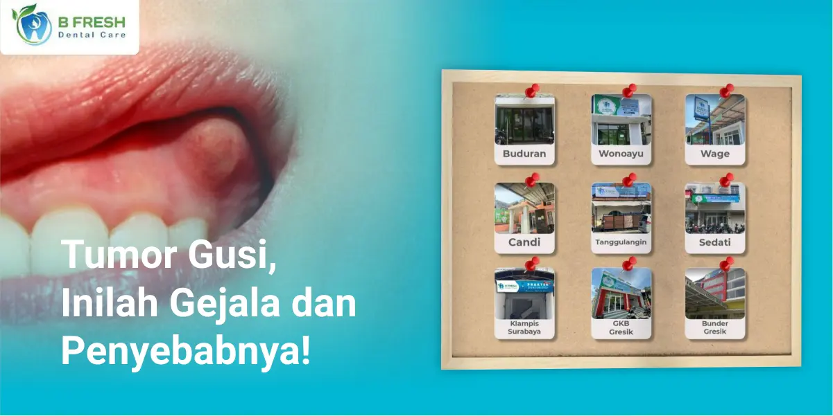 Tumor Gusi, Inilah Gejala Dan Penyebabnya!