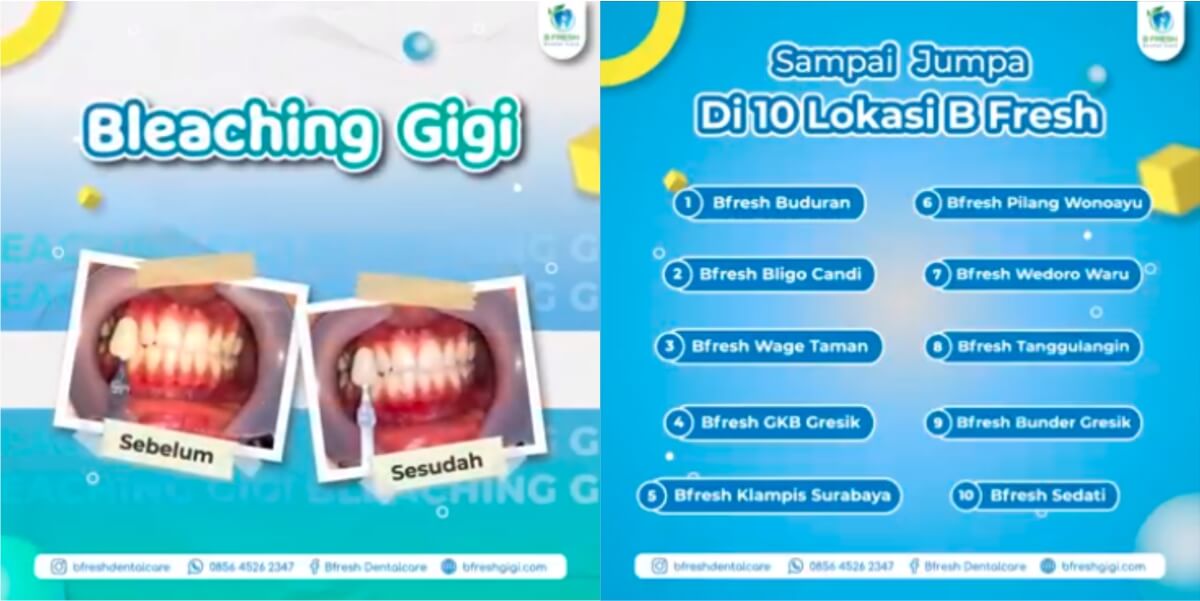 Testimoni Bleaching Gigi