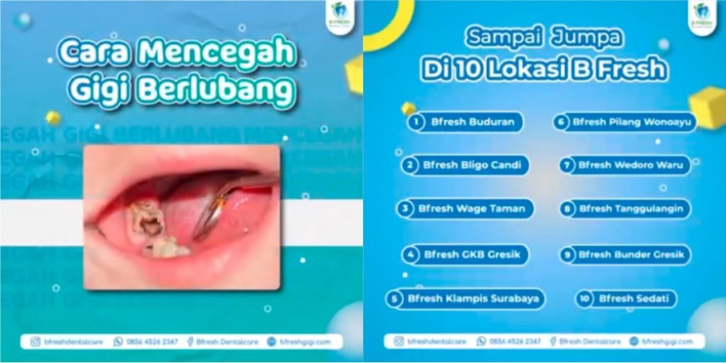 Cara Mencegah Gigi Berlubang Bfresh Dental Care