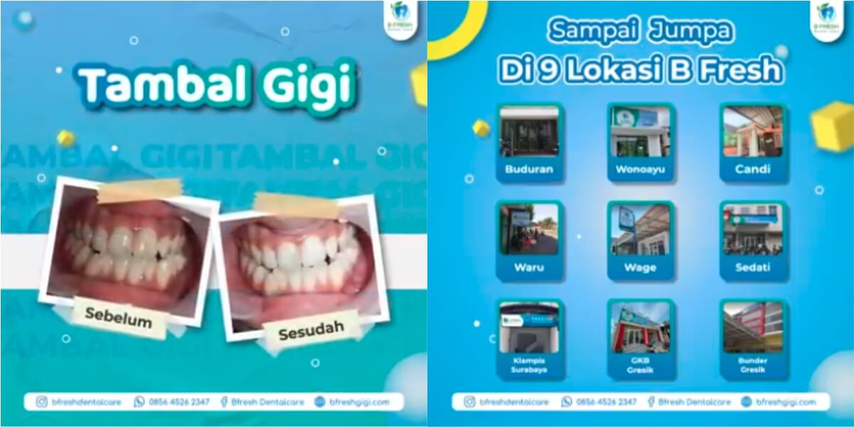 Tambal Gigi