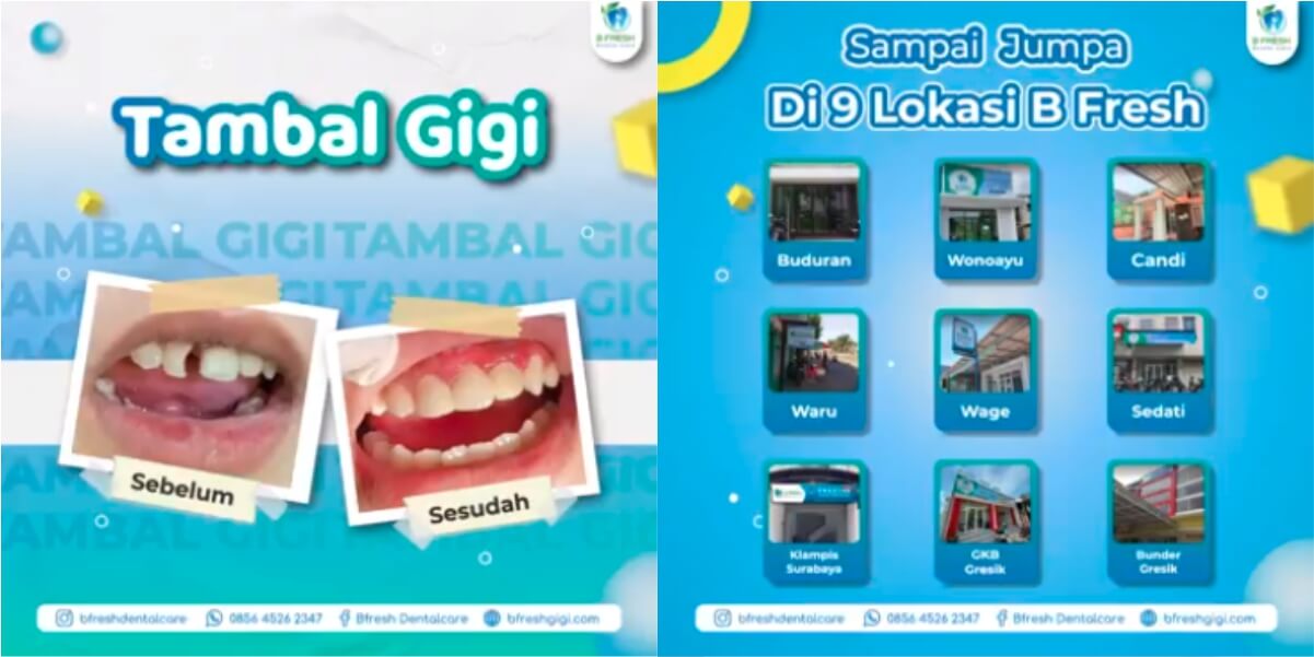 Tambal Gigi