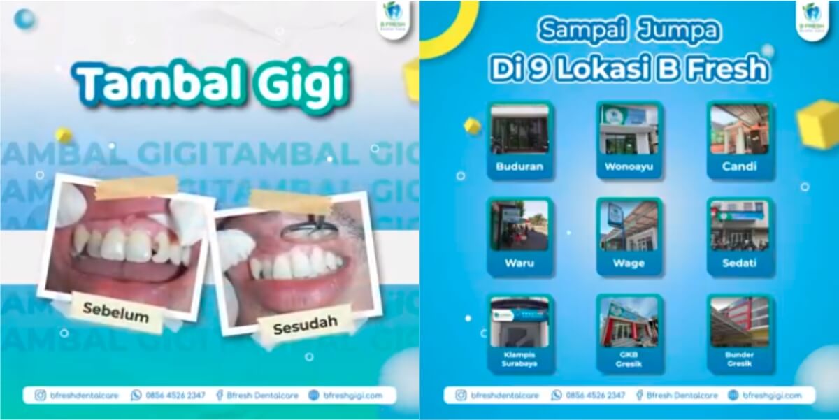 Tambal Gigi