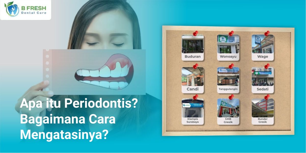 Apa itu Periodontis? Bagaimana Cara Mengatasinya?