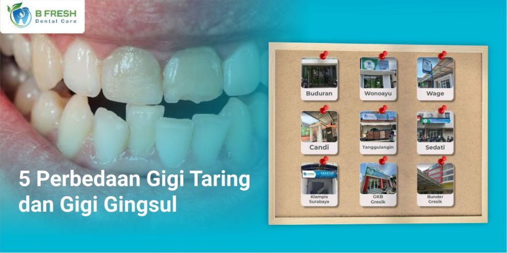 5 Perbedaan Gigi Taring Dan Gigi Gingsul Bfresh Dental Care