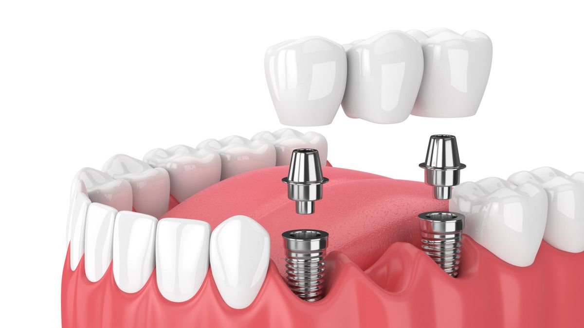 Perawatan Pasca Pemasangan Implan Gigi: Tips dan Saran