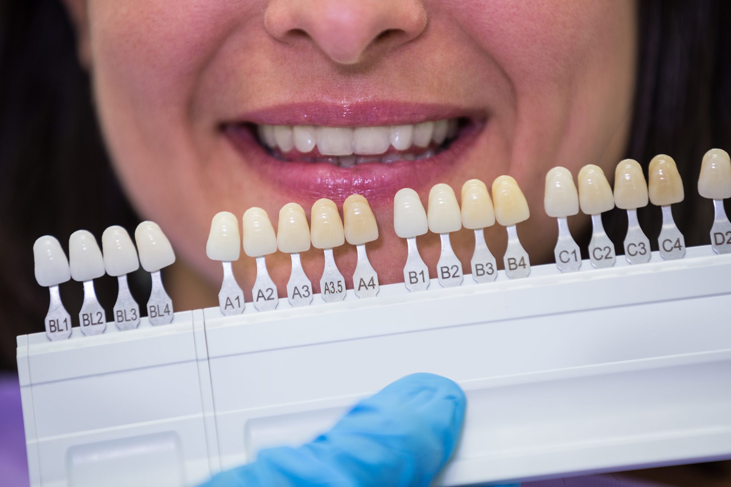 Mengenal Veneer Gigi: Prosedur dan Manfaatnya