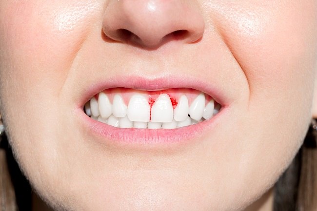 Pentingnya Perawatan Gigi Secara Teratur untuk Kesehatan Mulut yang Optimal