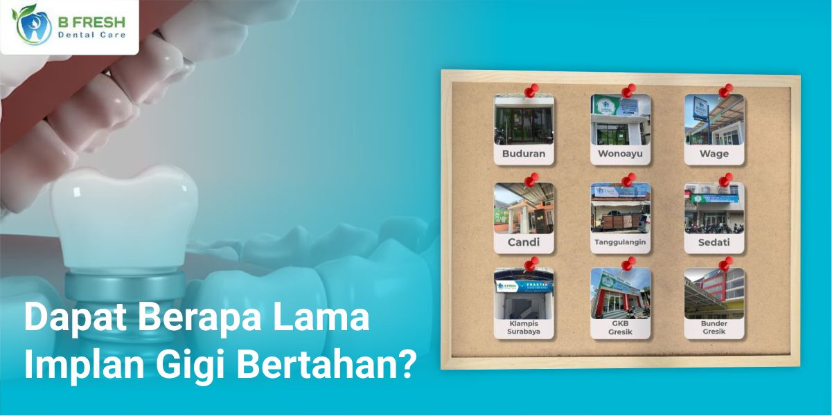 Dapat Berapa Lama Implan Gigi Bertahan?