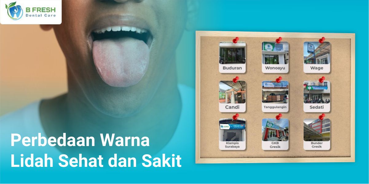 Perbedaan Warna Lidah Sehat dan Sakit - Bfresh Dental Care